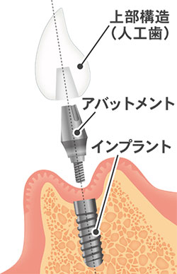 インプラントの構造