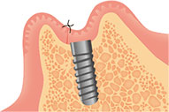 インプラント埋入後