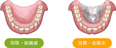 総入れ歯