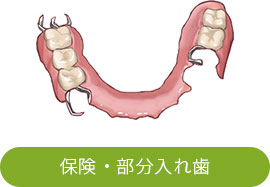 部分入れ歯