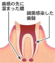 根管の長さを測定