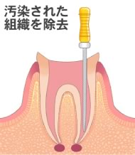 根管の掃除