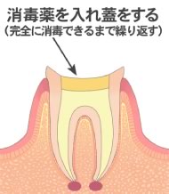 薬剤による消毒・殺菌