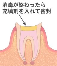 根管充填