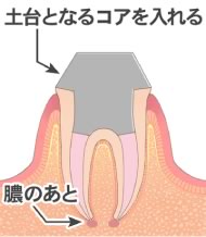 歯根に土台を入れる