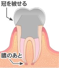 かぶせ物をする