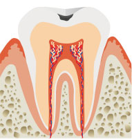初期 エナメル質の虫歯のイメージ画像