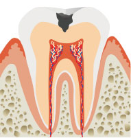 中期 象牙質の虫歯のイメージ画像