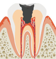 後期 神経まで進行した虫歯のイメージ画像