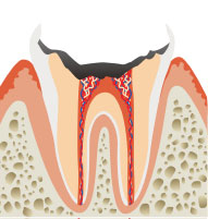 後期 神経まで進行した虫歯のイメージ画像