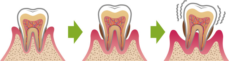 歯周病の原因となるプラーク