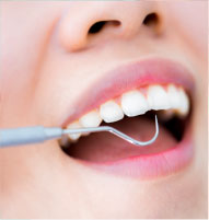 歯石除去のイメージ画像