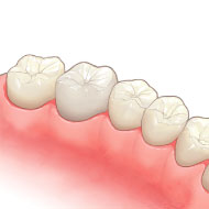 オールセラミッククラウン