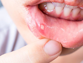 治し 口内炎 方 白い 口内炎の治し方8選｜歯科衛生士がお口の悩みに答えます