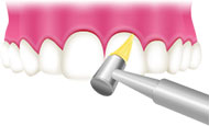 歯と歯の隙間を清掃